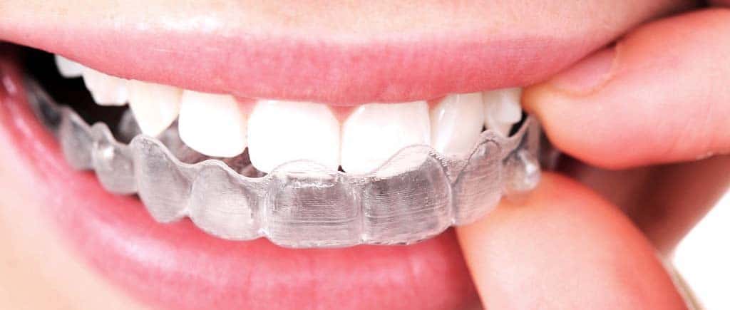 Orthodontic Treatment: The Use Of Dental Braces
